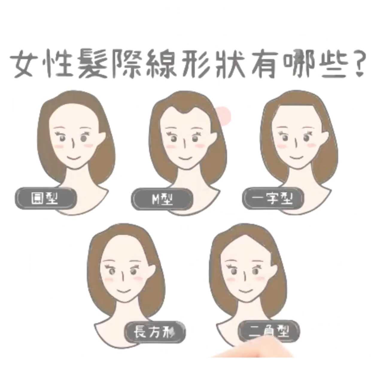 如何改善女性髮際線形狀？全面解析各種髮際線類型